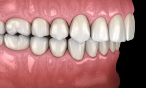 Do You Need Braces if You Have an Overbite?