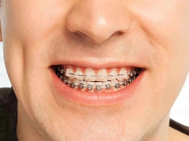 Man smiling with clear and traditional braces